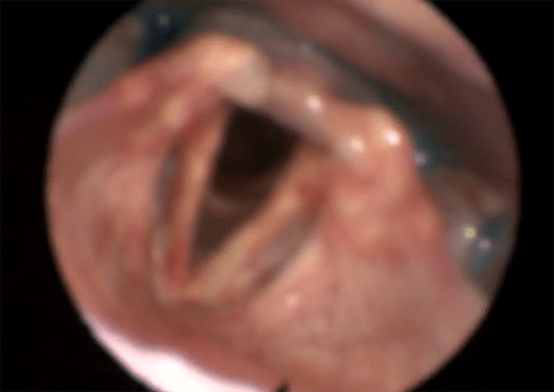 Dysphagia_FEES_1