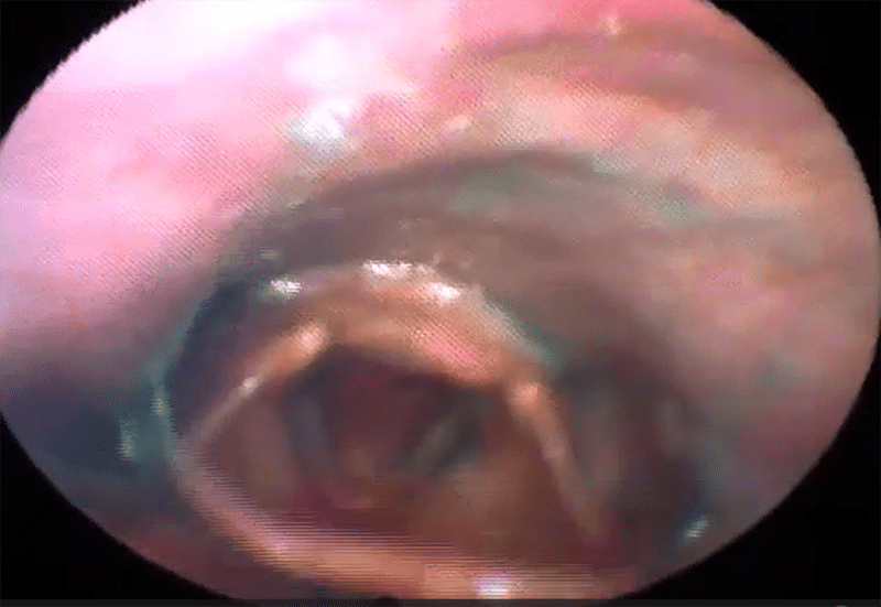 Dysphagia_FEES_2