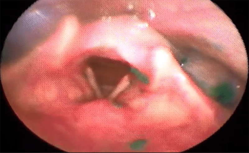 Dysphagia_FEES_3