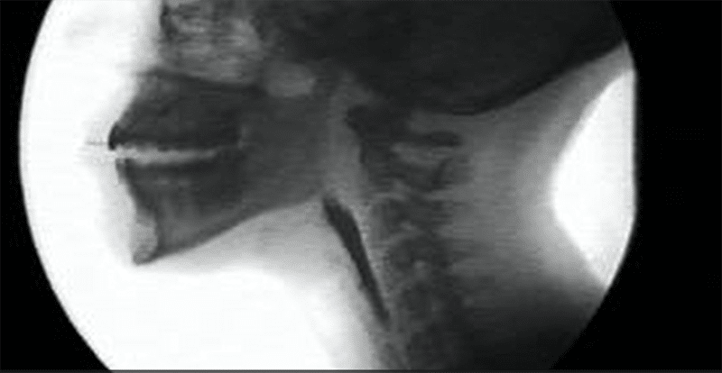 Dysphagia_VFSS_2