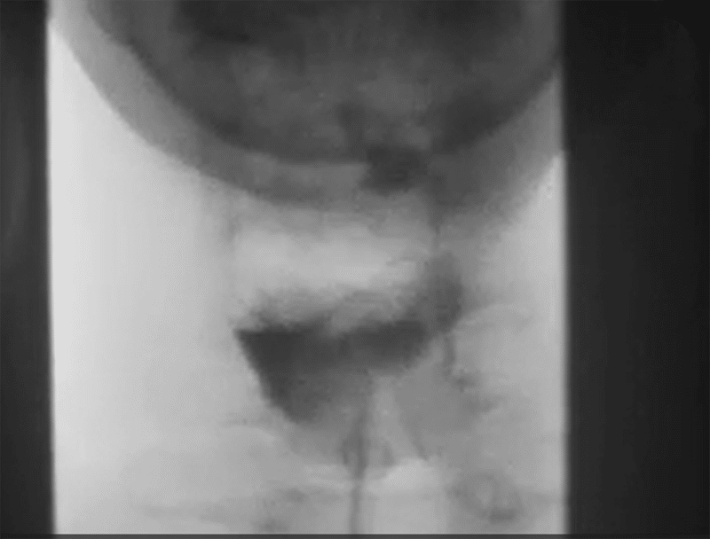 Dysphagia_VFSS_3