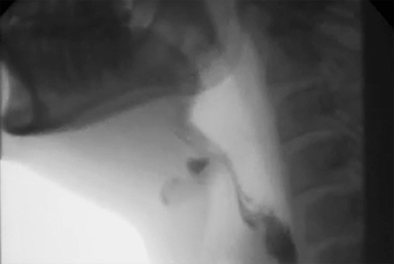 Dysphagia_VFSS_4